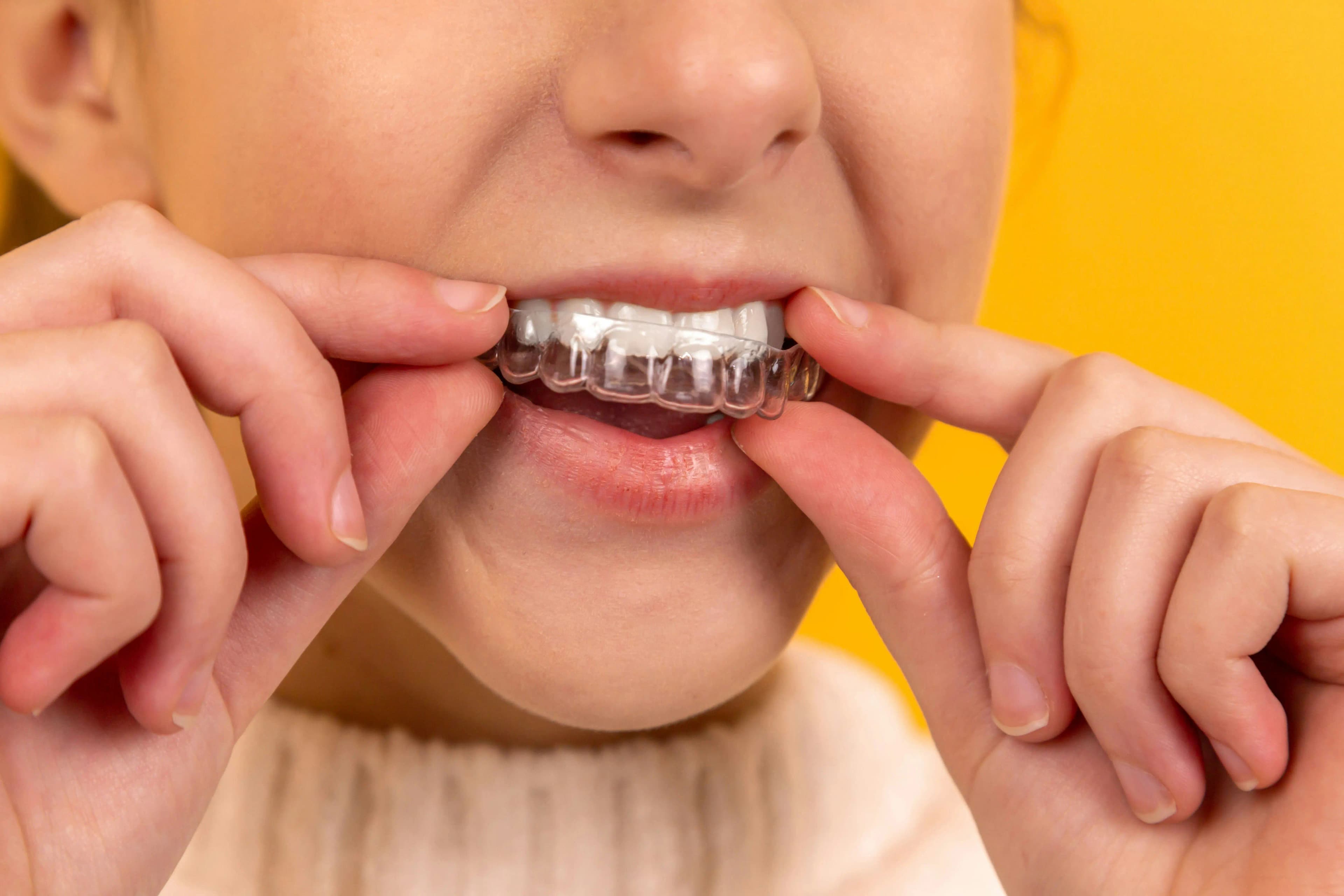 Mouth Guard Services