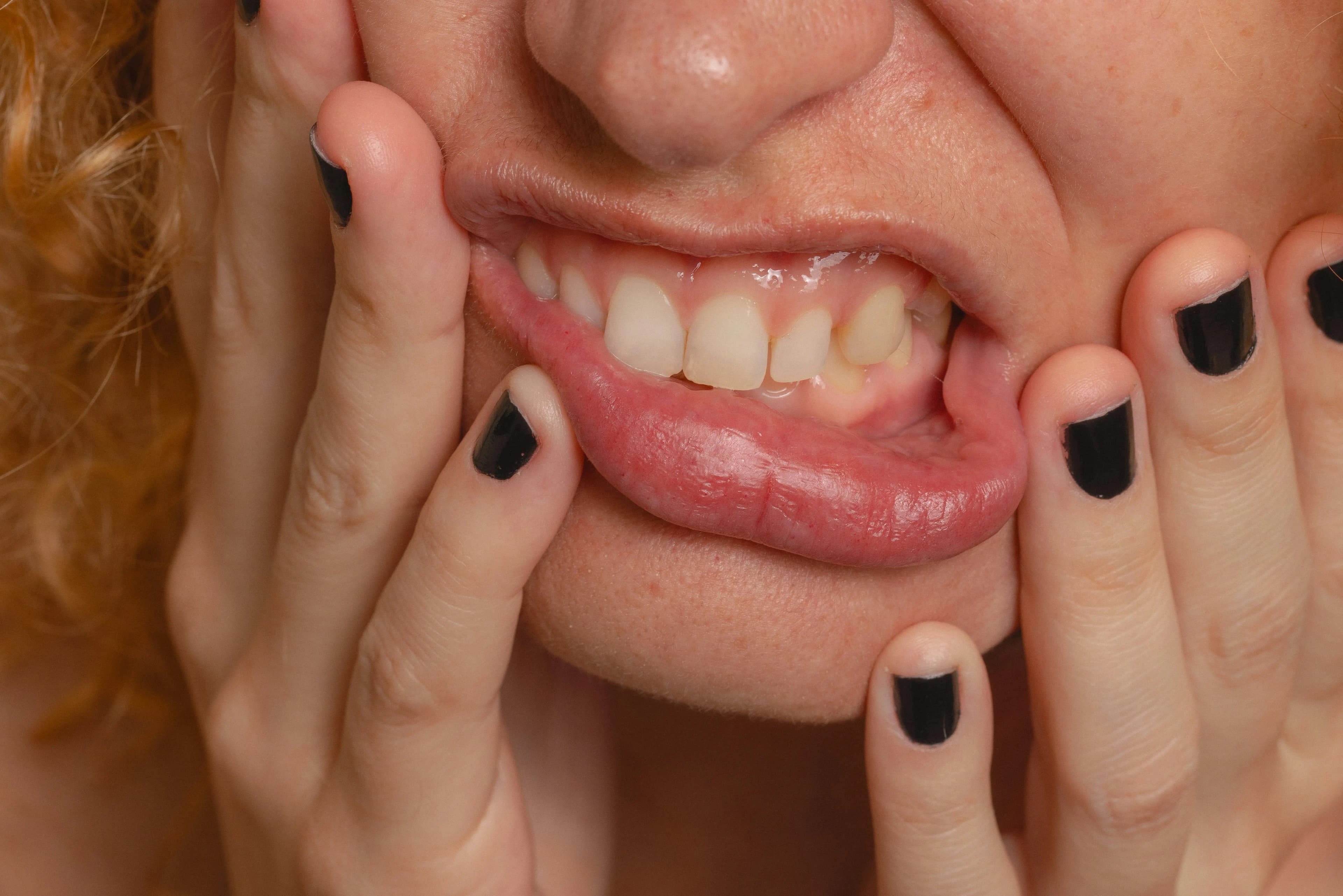 Gingivitis Treatment Specialists