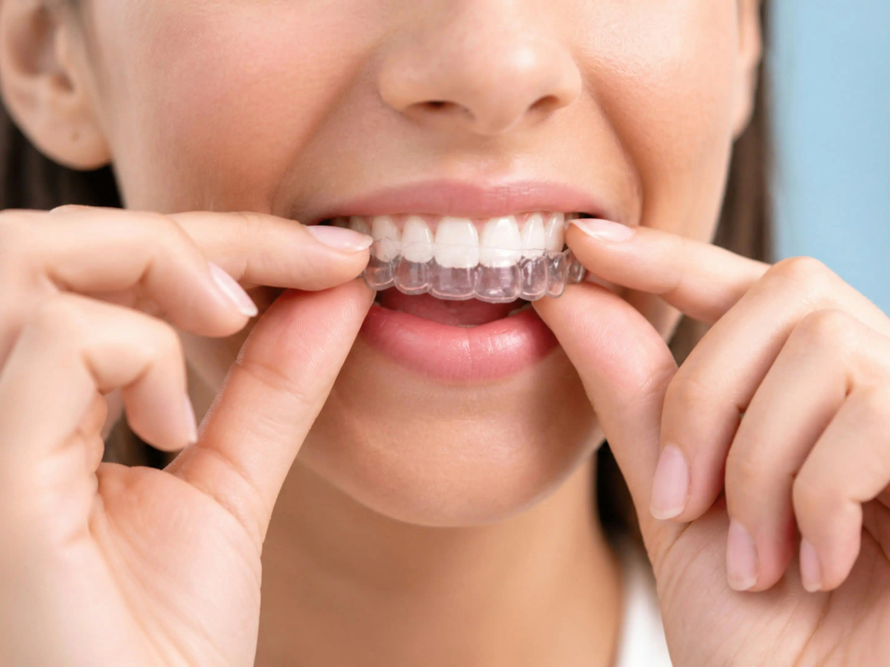 Invisalign for Your Smile