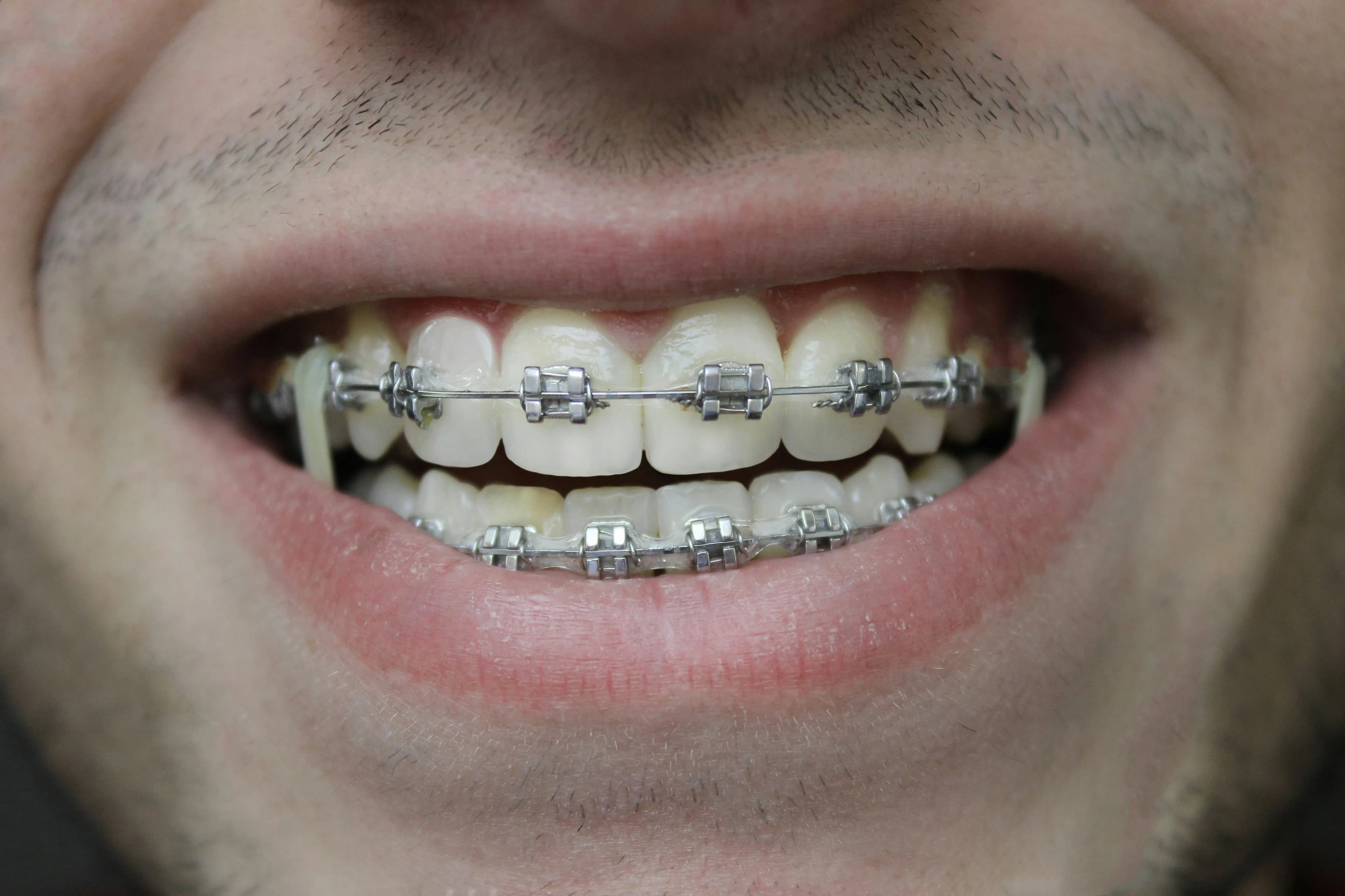 Orthodontic Services and Treatments