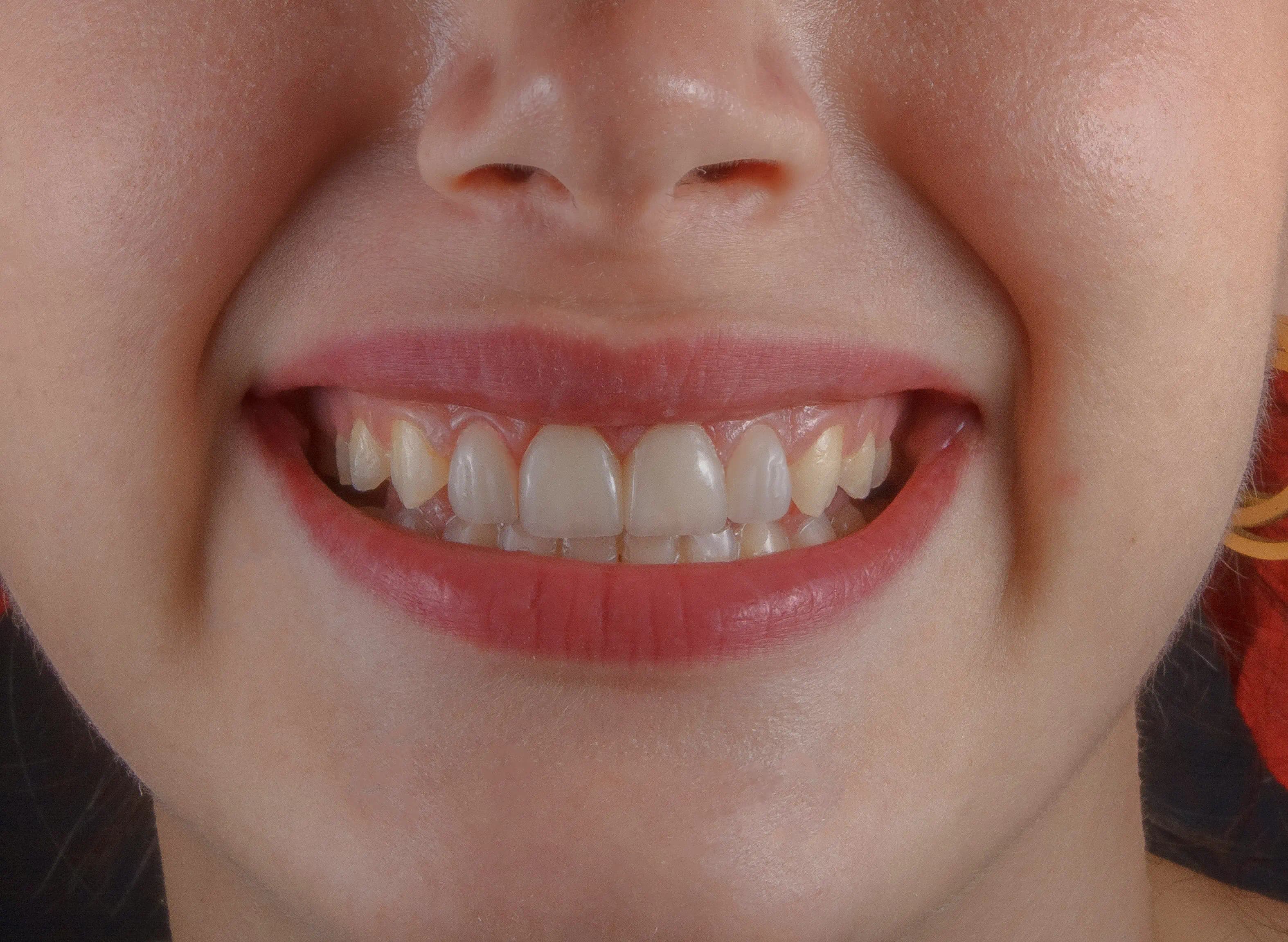 Smile Makeover Services