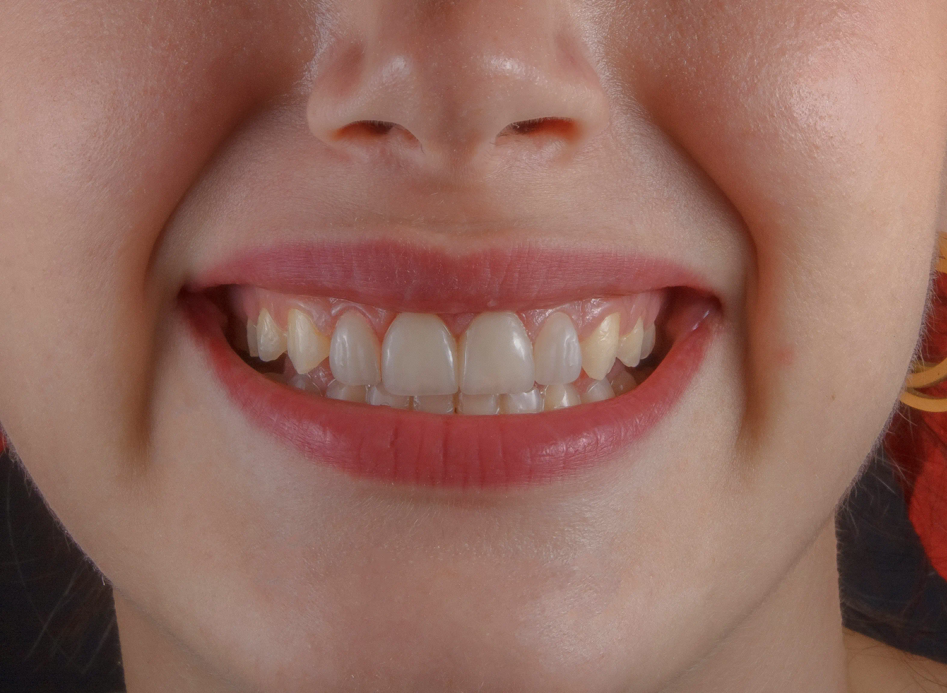 Smile Makeover Services